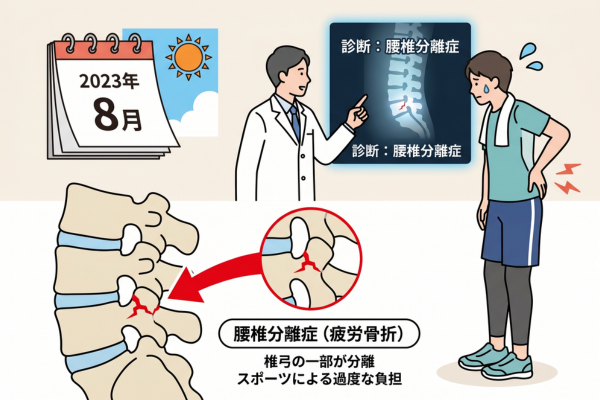 2023年夏に腰椎分離症と診断されたというイメージ図解画像